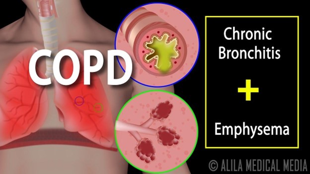 COPD