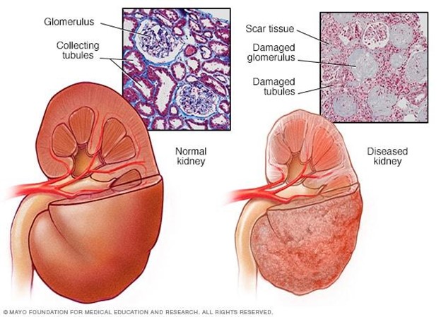 Kidney Disease