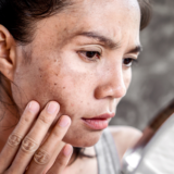 common skin conditions